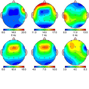 نقشه فعالیت الکتریکی مغز QEEG